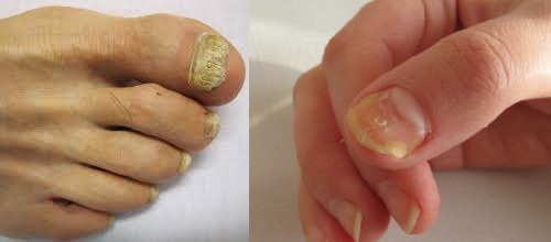 Nail Fungus and its treatment